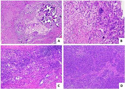 Assessing Post-Treatment Pathologic Tumor Response in Female Genital Tract Carcinomas: An Update